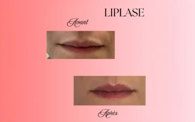 Sublimer les lèvres : une prise en charge personnalisée