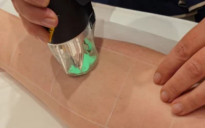 Les avantages de l’épilation laser médicale